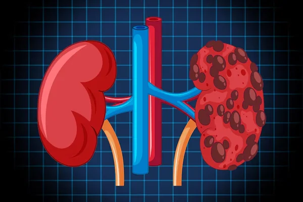 Acute Kidney Injury