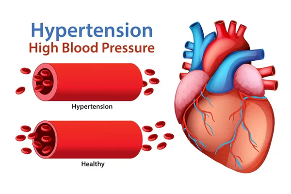 Hypertension